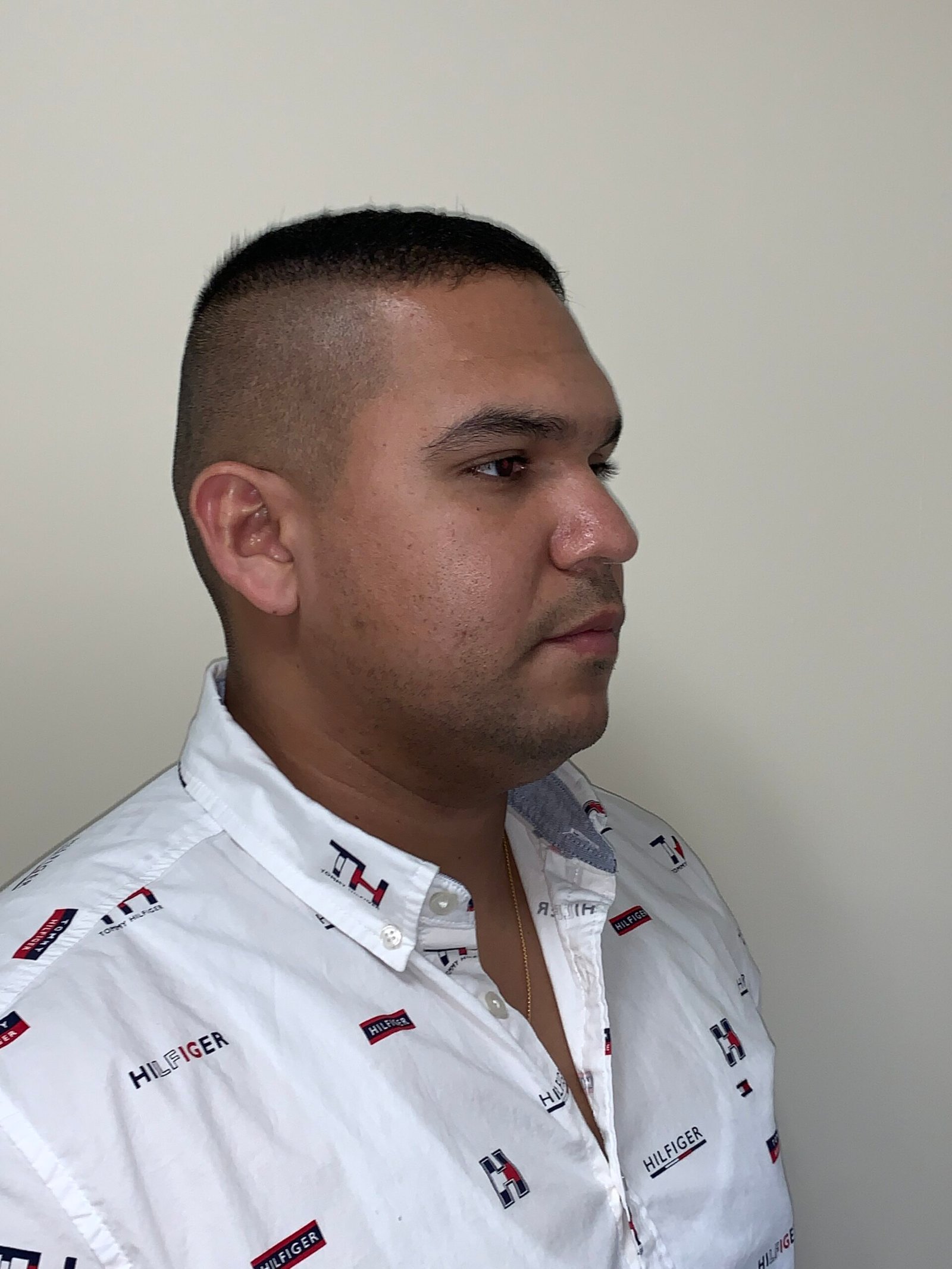 Rhinoplasty before and after - before