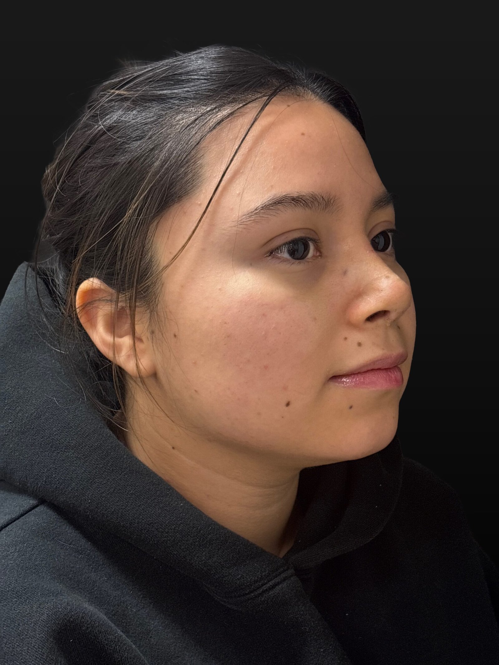 Rhinoplasty before and after - after