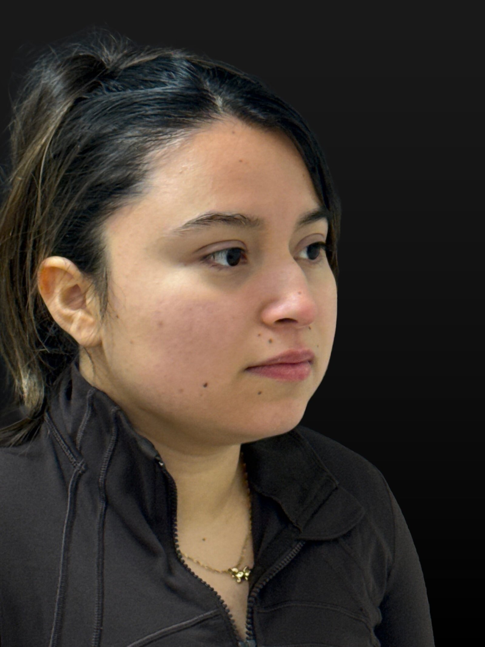 Rhinoplasty before and after - before