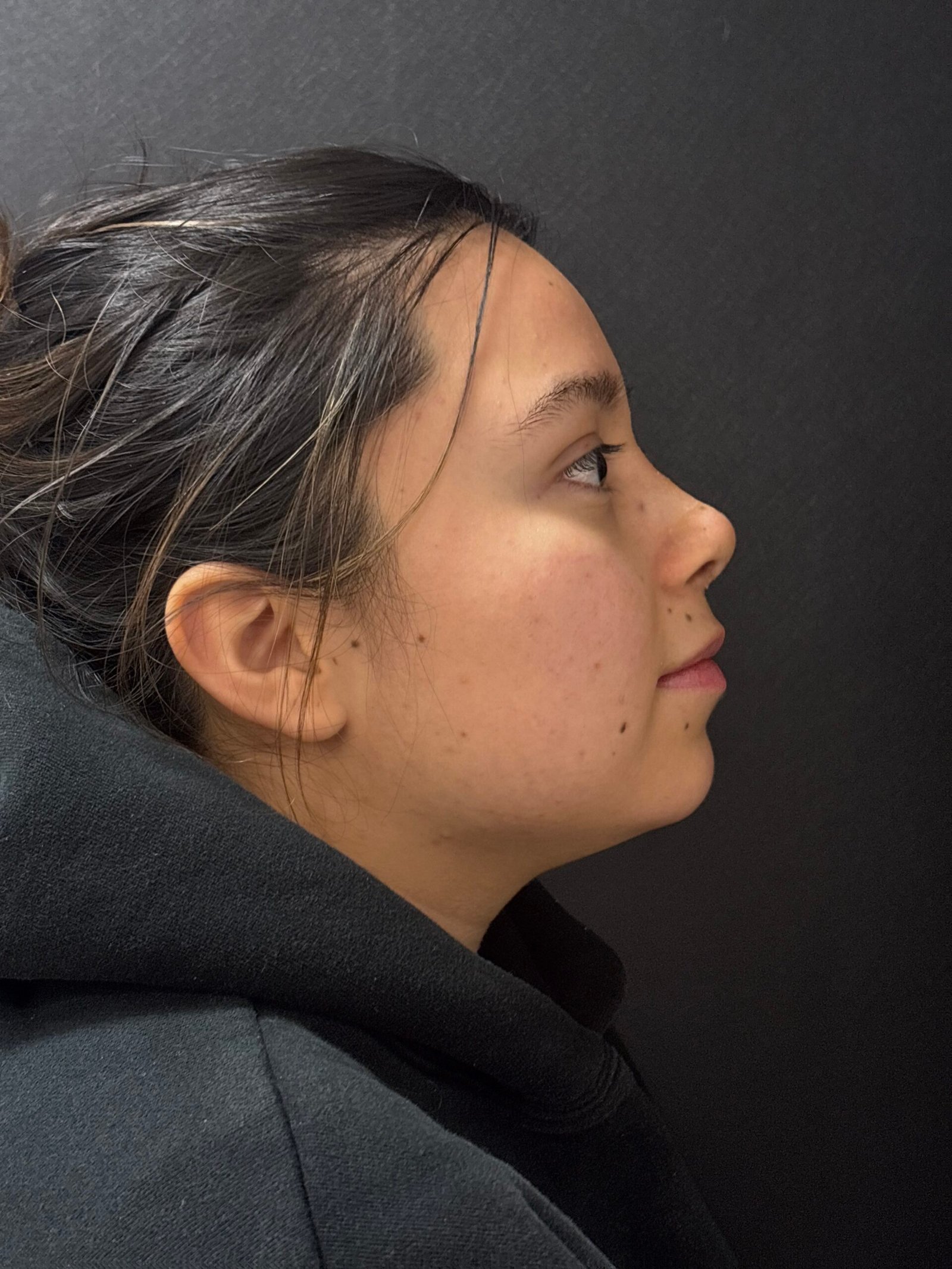 Rhinoplasty before and after - after