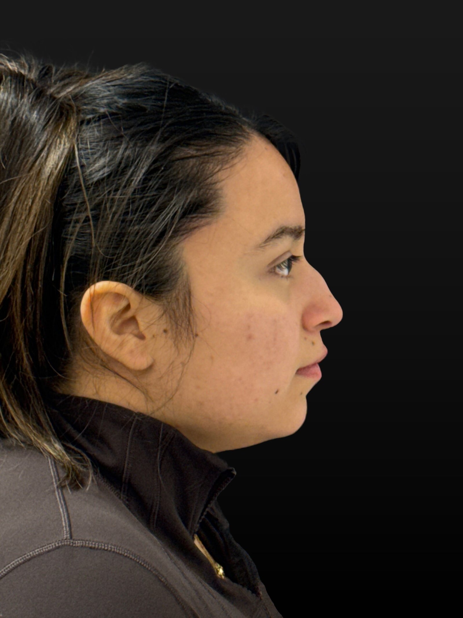 Rhinoplasty before and after - before