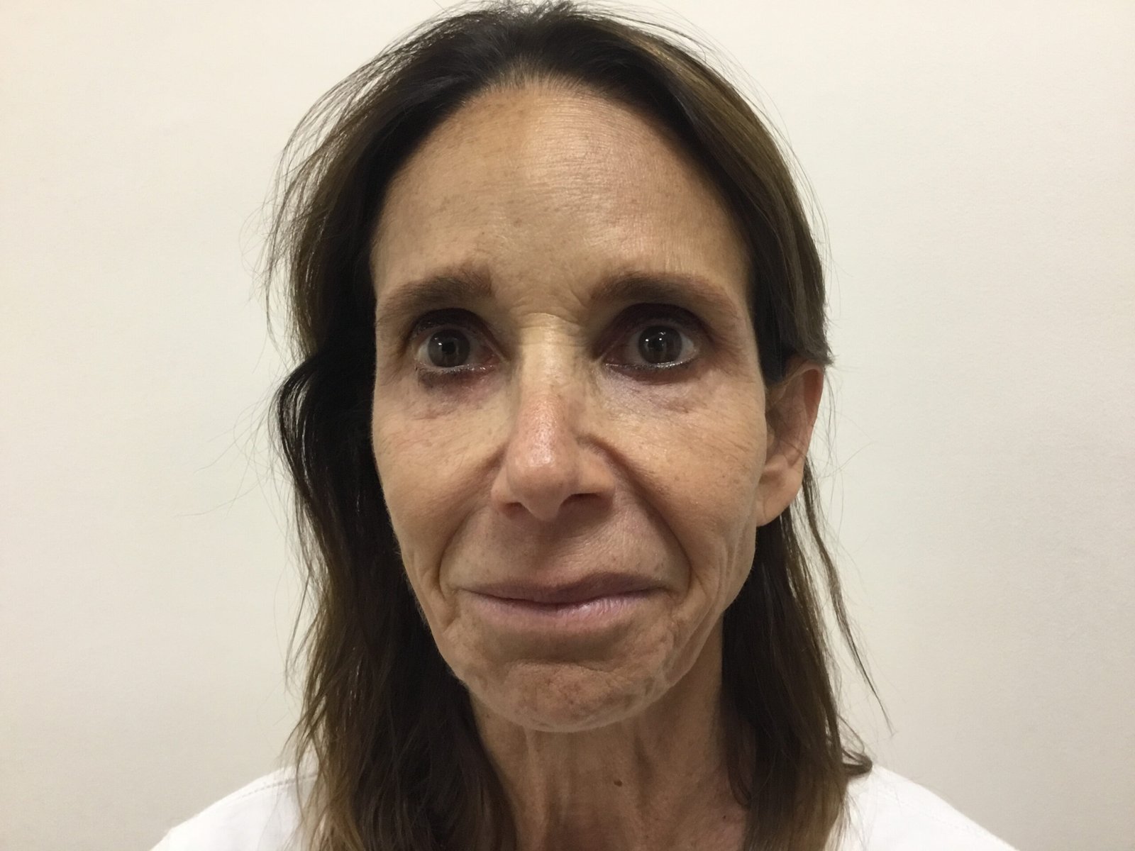 Cheek Filler before and after - after