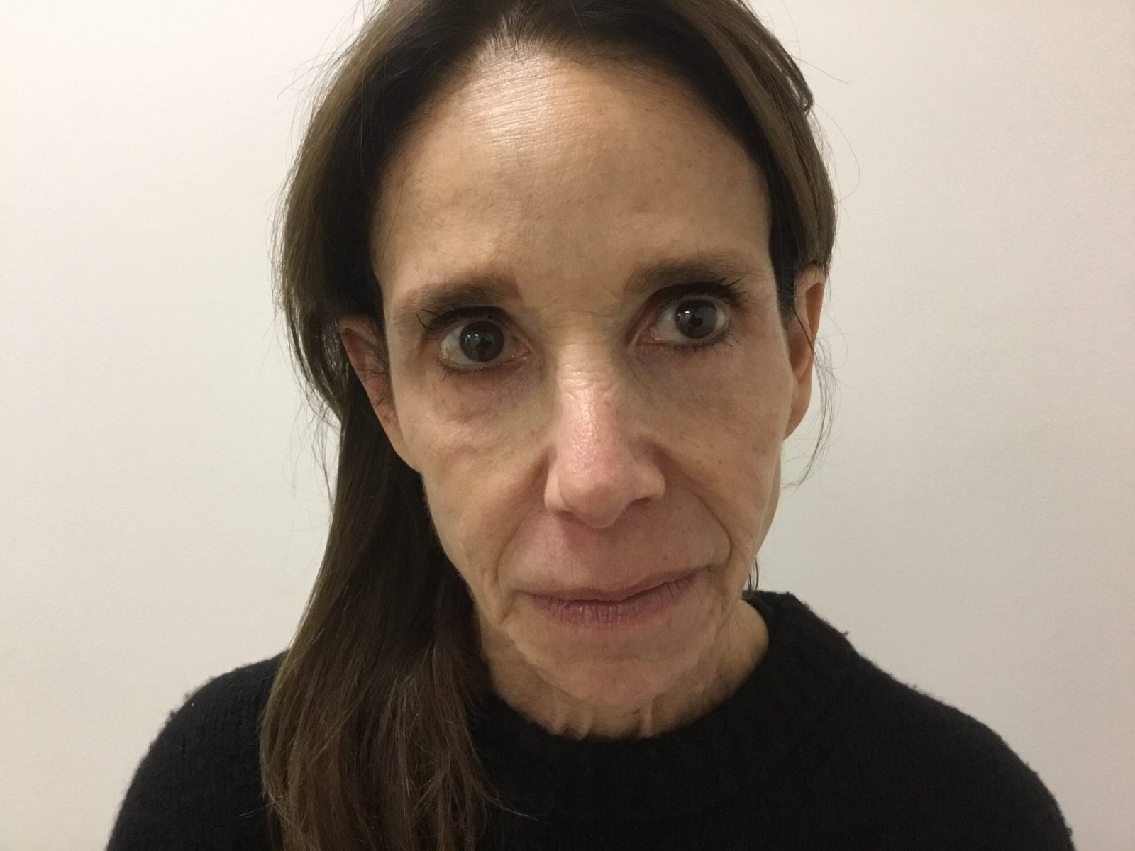 Cheek Filler before and after - before