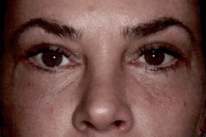Blepharoplasty before and after - after