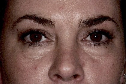 Blepharoplasty before and after - before
