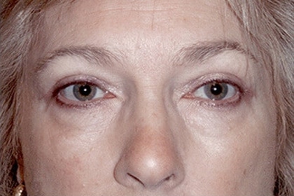 Blepharoplasty before and after - after