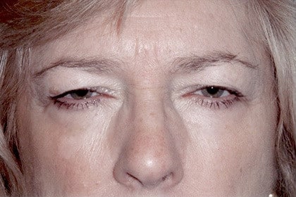 Blepharoplasty before and after - before