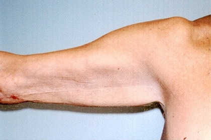 Brachioplasty before and after - after