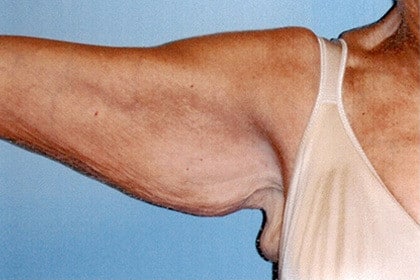 Brachioplasty before and after - before