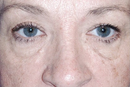 Blepharoplasty before and after - before