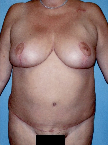 Mommy Makeover by Dr. Victor Schingo — after