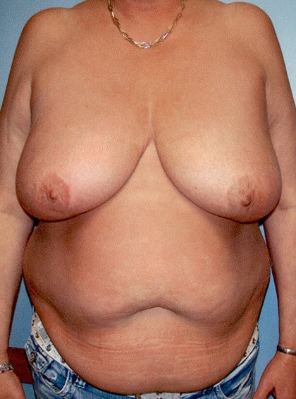 Mommy Makeover by Dr. Victor Schingo — before