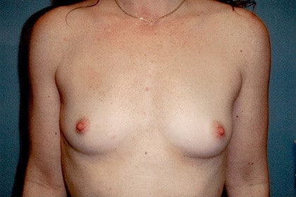 Breast Augmentation before and after - before