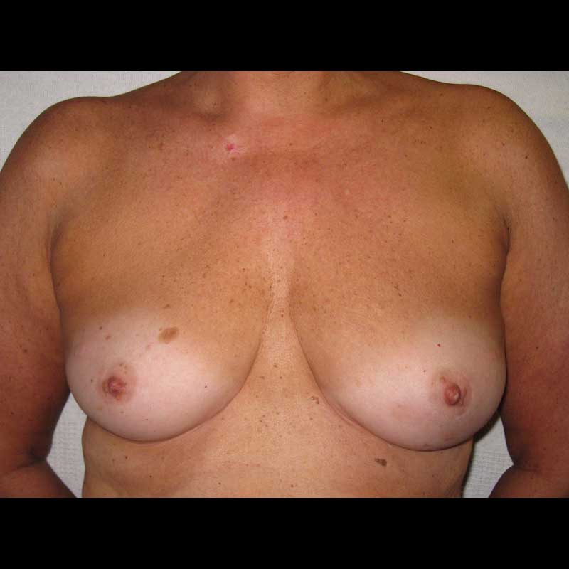 Breast Reconstruction before — Dr. Ron Israeli