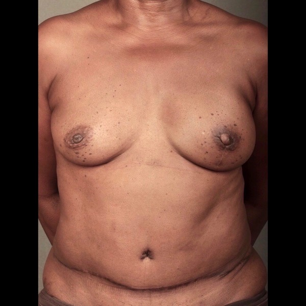 Breast Reconstruction Diep Flap: Nipple Sparing Mastectomy before and after - after