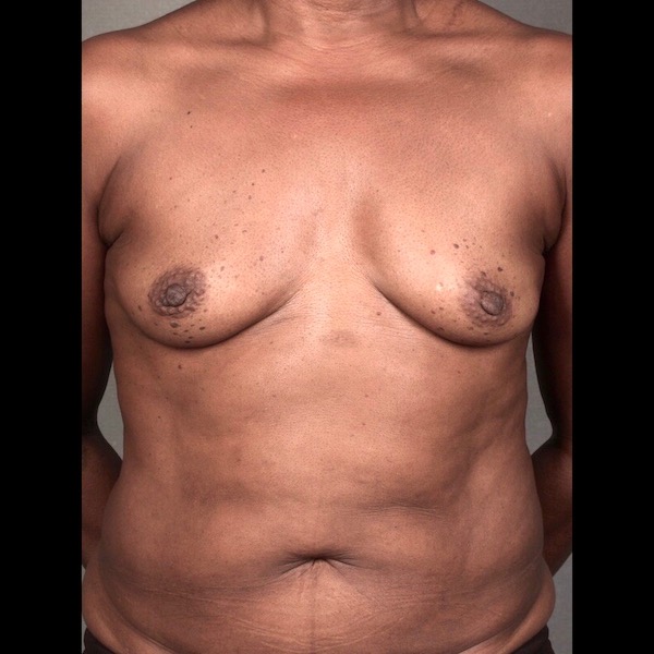 Breast Reconstruction Diep Flap: Nipple Sparing Mastectomy before and after - before