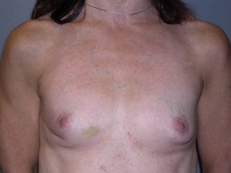 Breast Reconstruction before — Dr. Ron Israeli