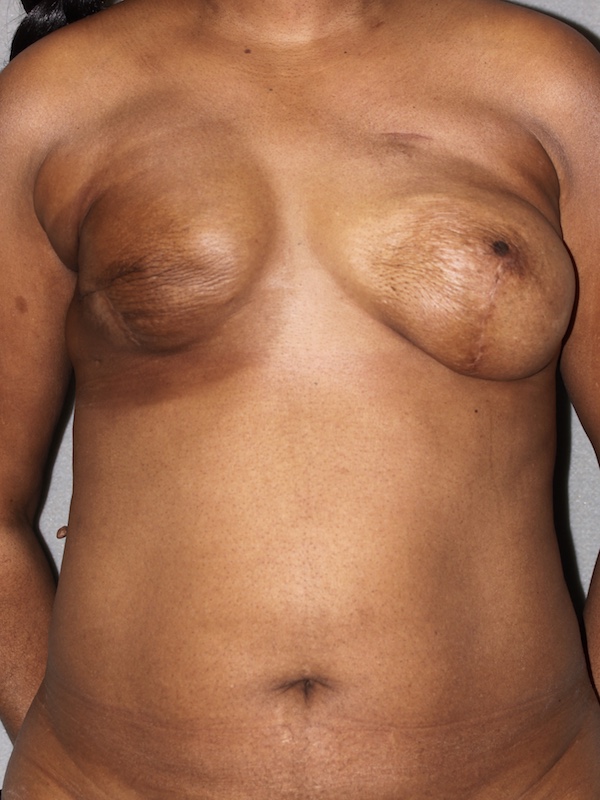Breast Reconstruction DIEP Flap before and after - before