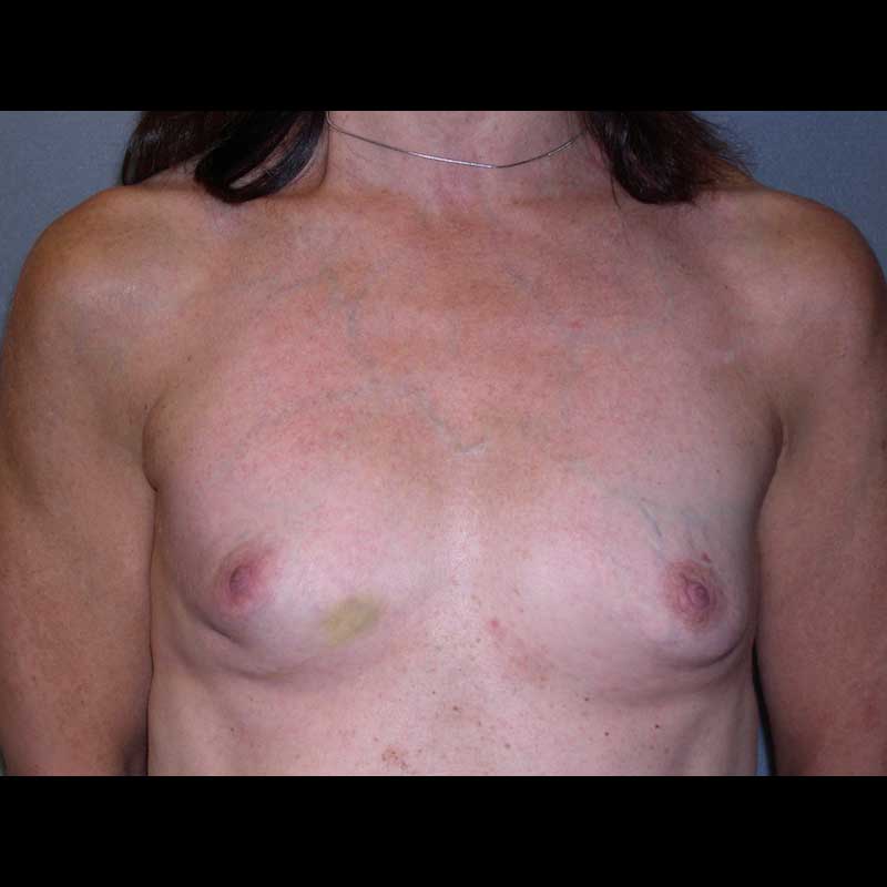 Breast Reconstruction before — Dr. Ron Israeli