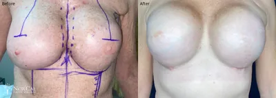 Breast Reconstruction before and after - before