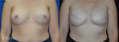 Breast Reconstruction before and after - after