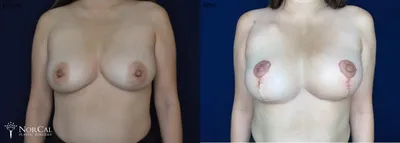 Breast Reconstruction before and after - before