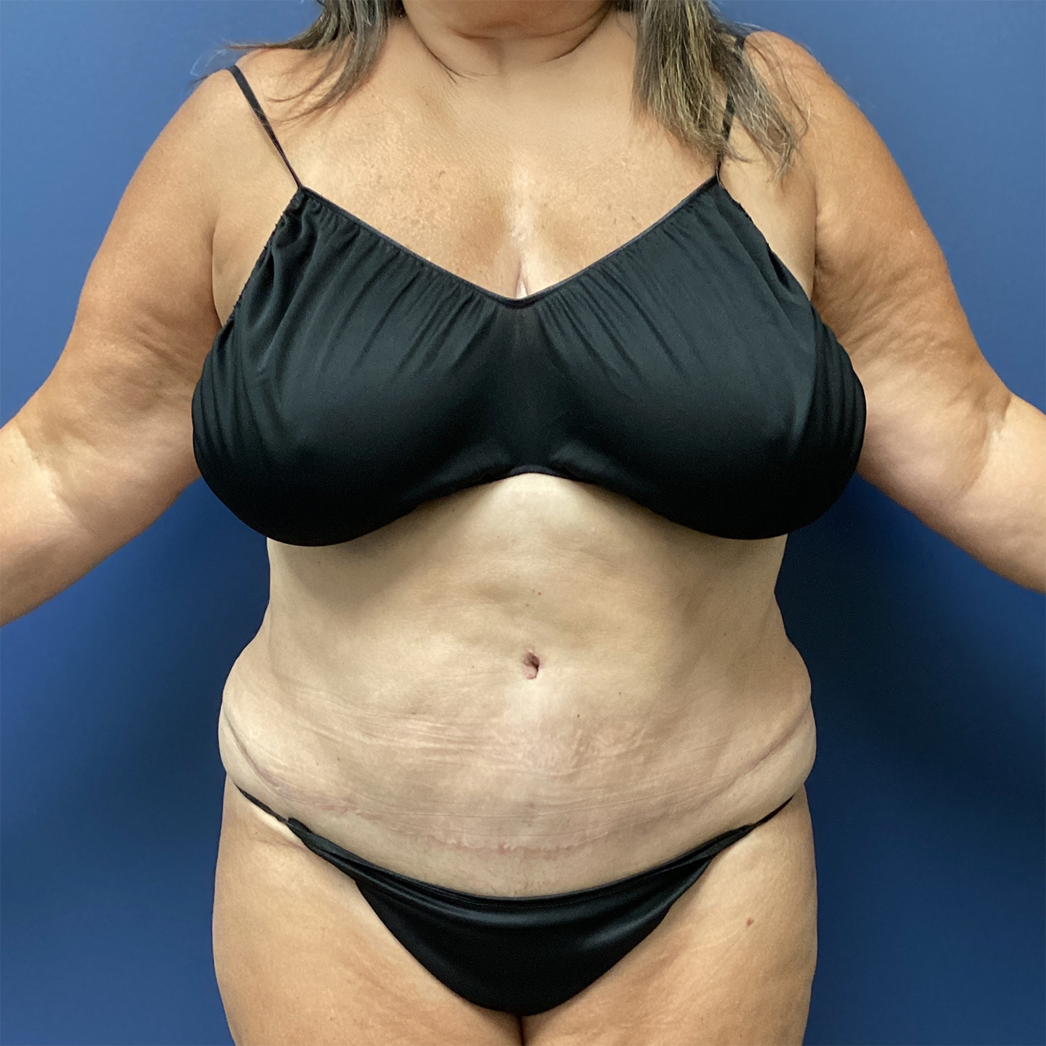 Tummy Tuck before and after - after