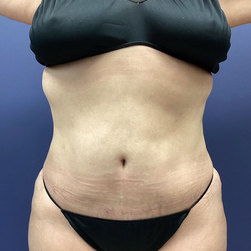 AbEX before and after - after