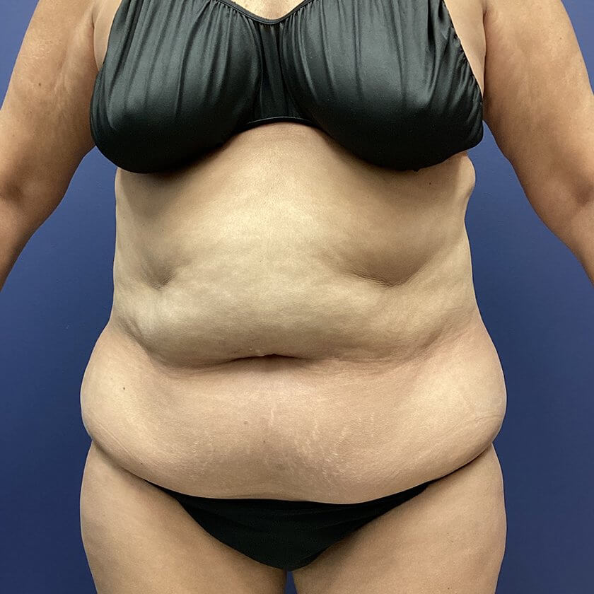 AbEX before and after - before