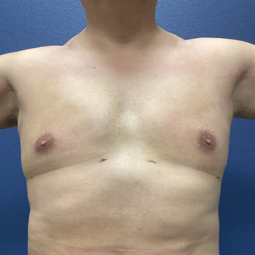 ChestEX before and after - after