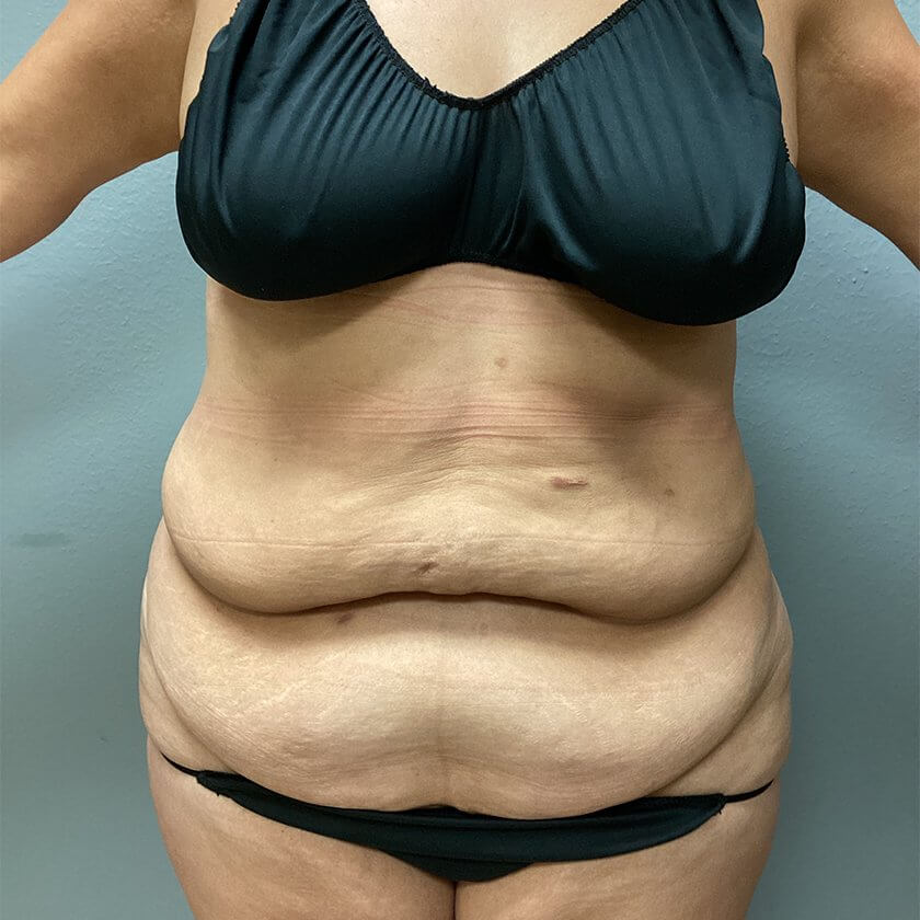 Tummy Tuck before and after - before