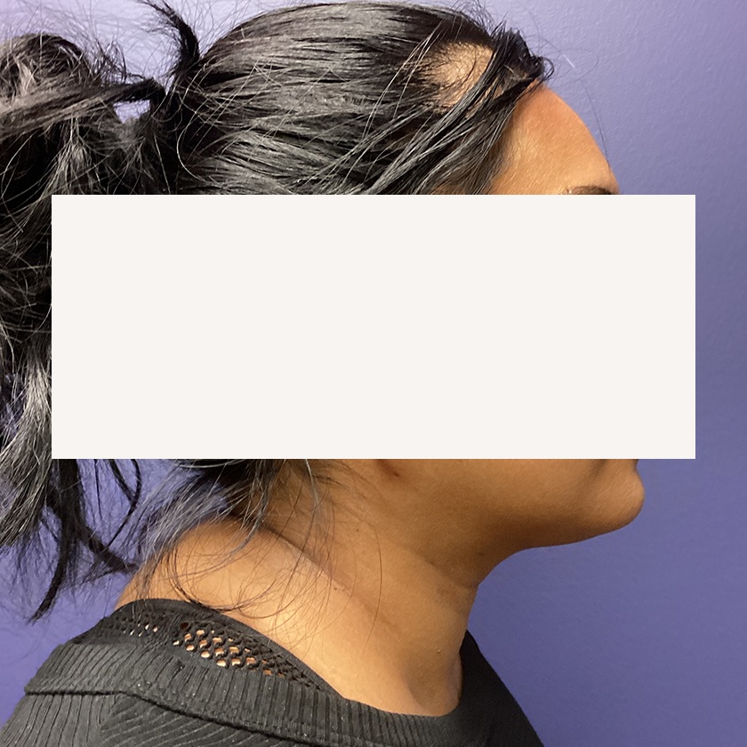 Chin before and after - after