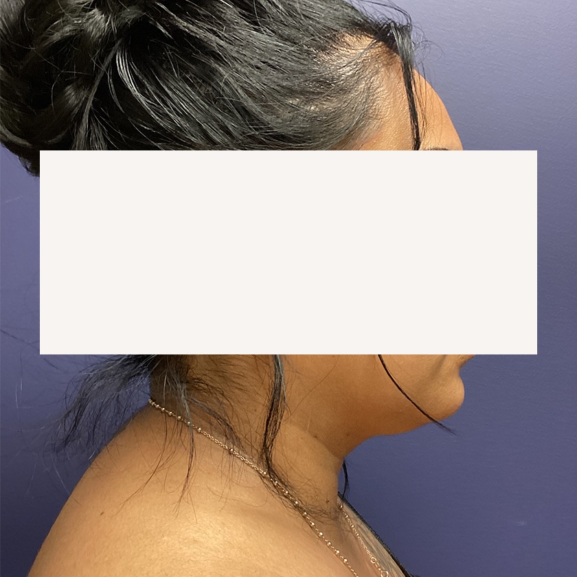 Chin before and after - before