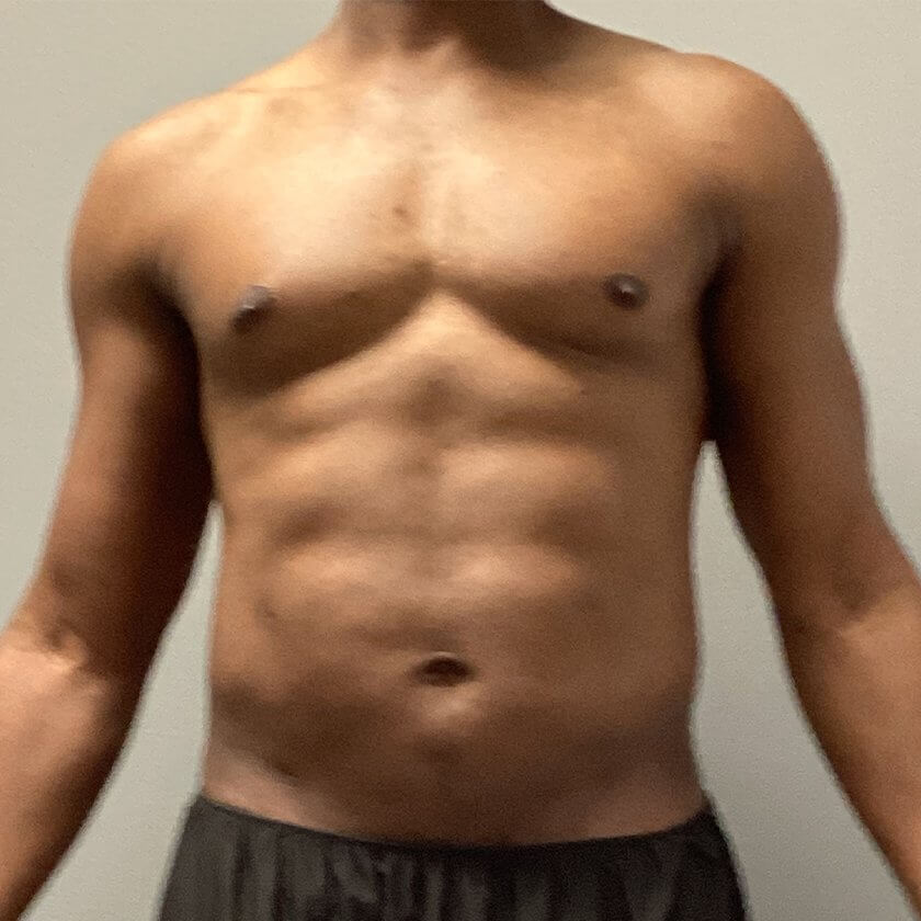 Liposuction before and after - after