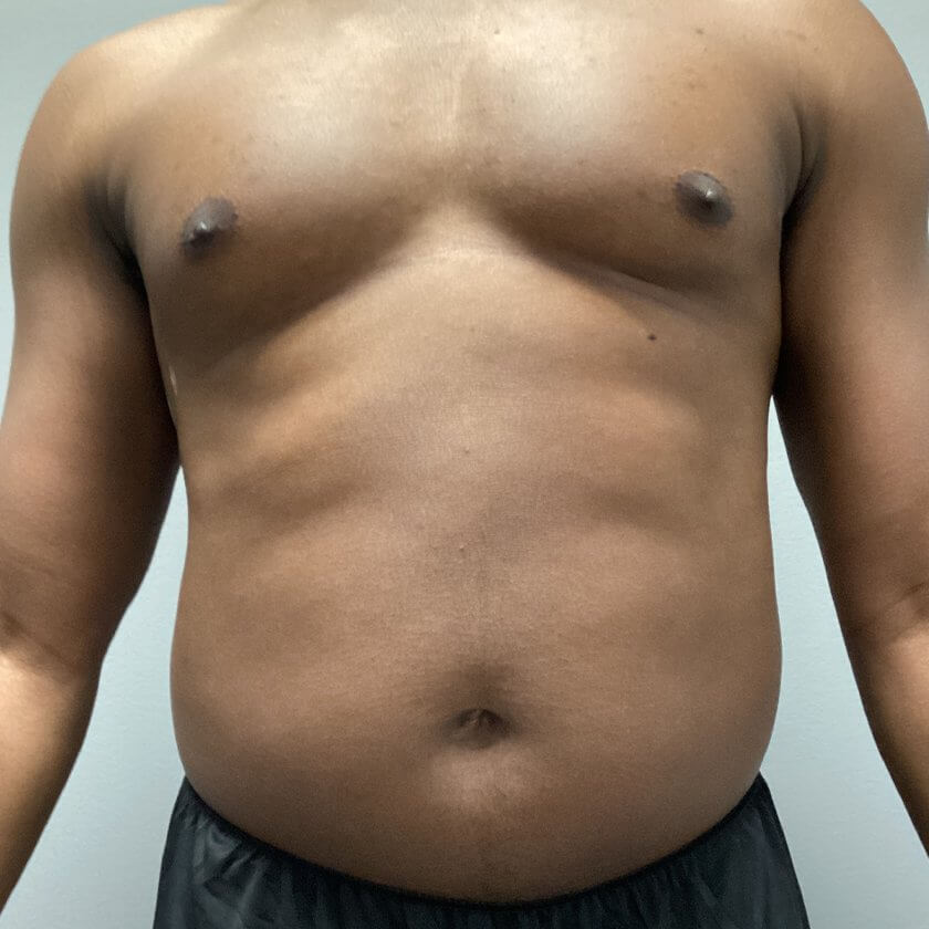 Liposuction before and after - before