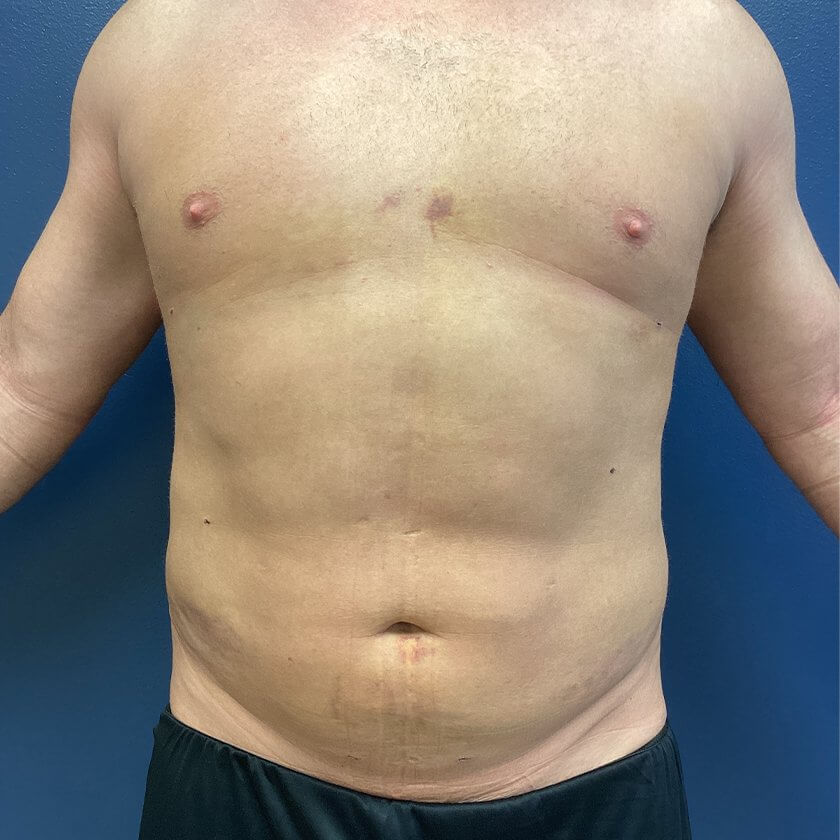 Liposuction before and after - after