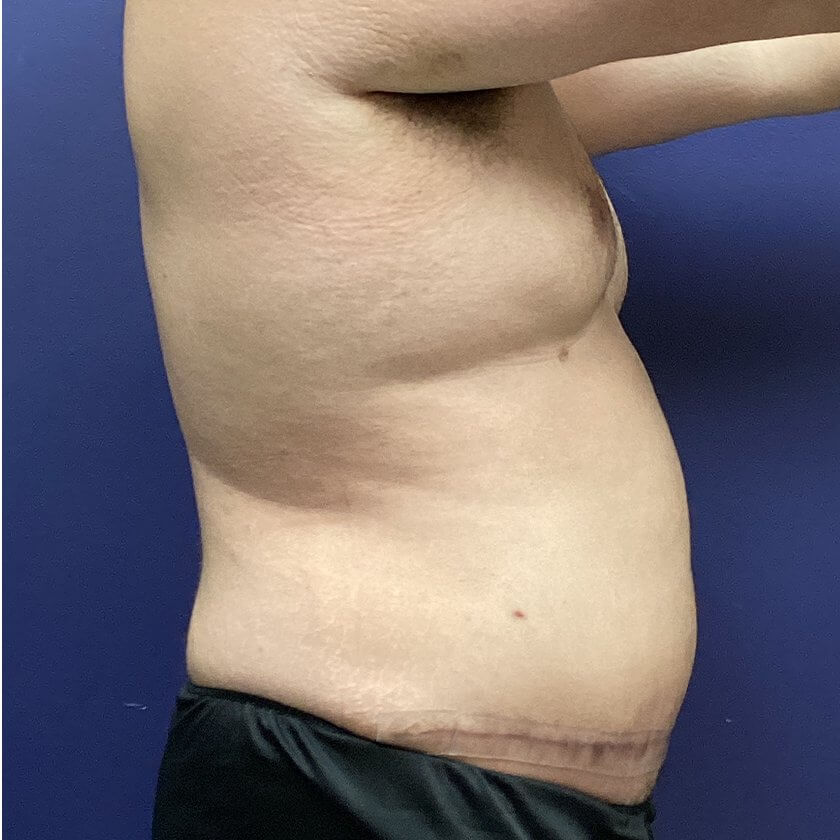 AbEX before and after - after
