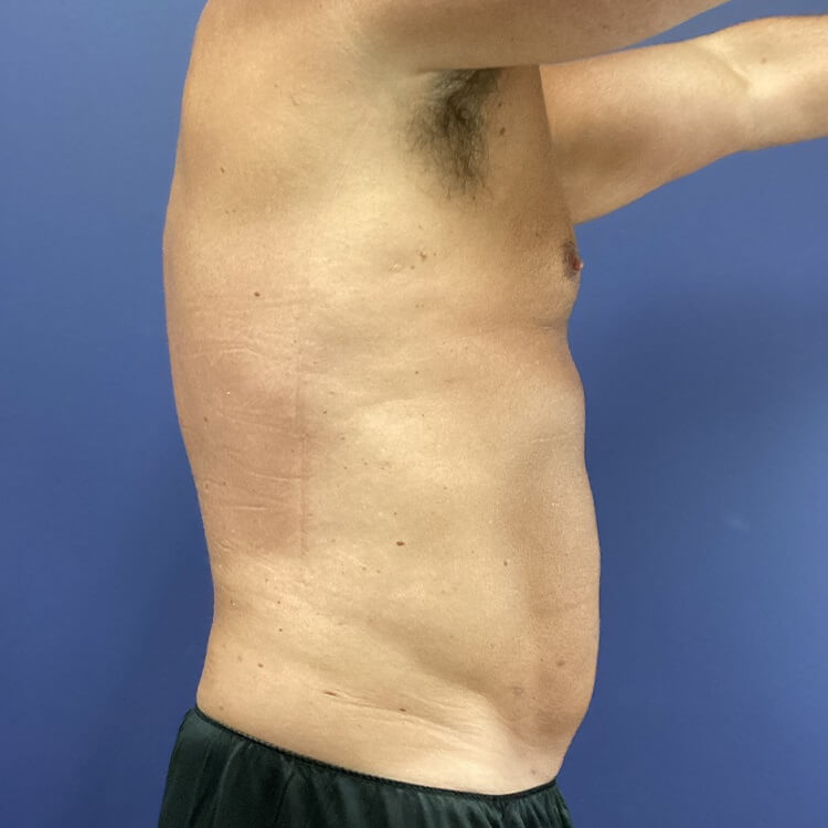 Liposuction before and after - after