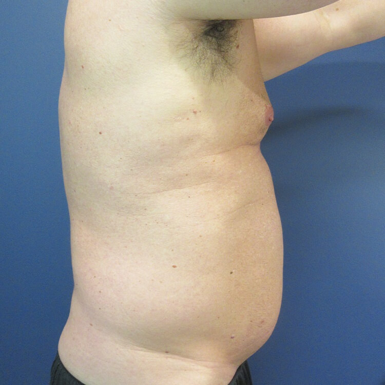 Liposuction before and after - before