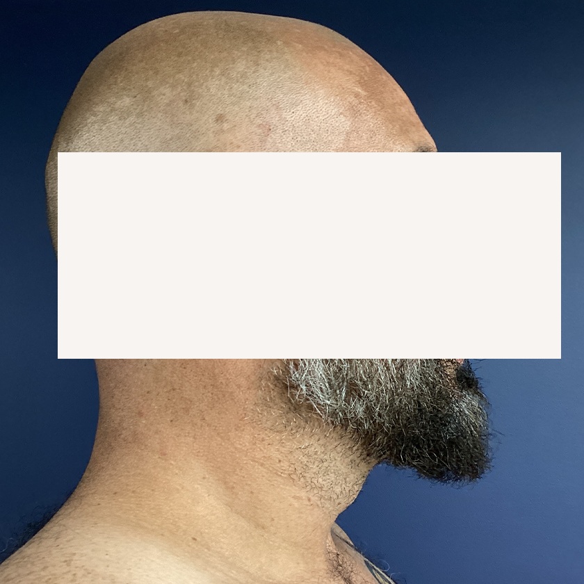 Chin before and after - after