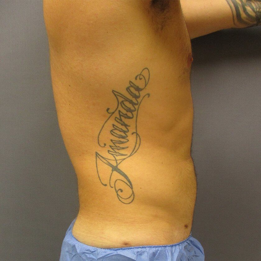 Liposuction before and after - after