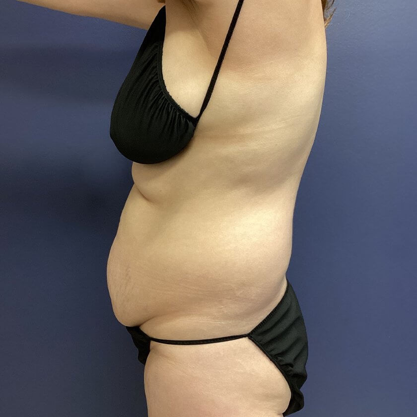 Mommy Makeover before and after - before