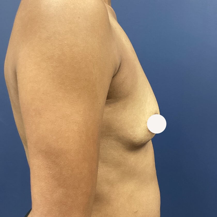 Breast Augmentation before and after - before