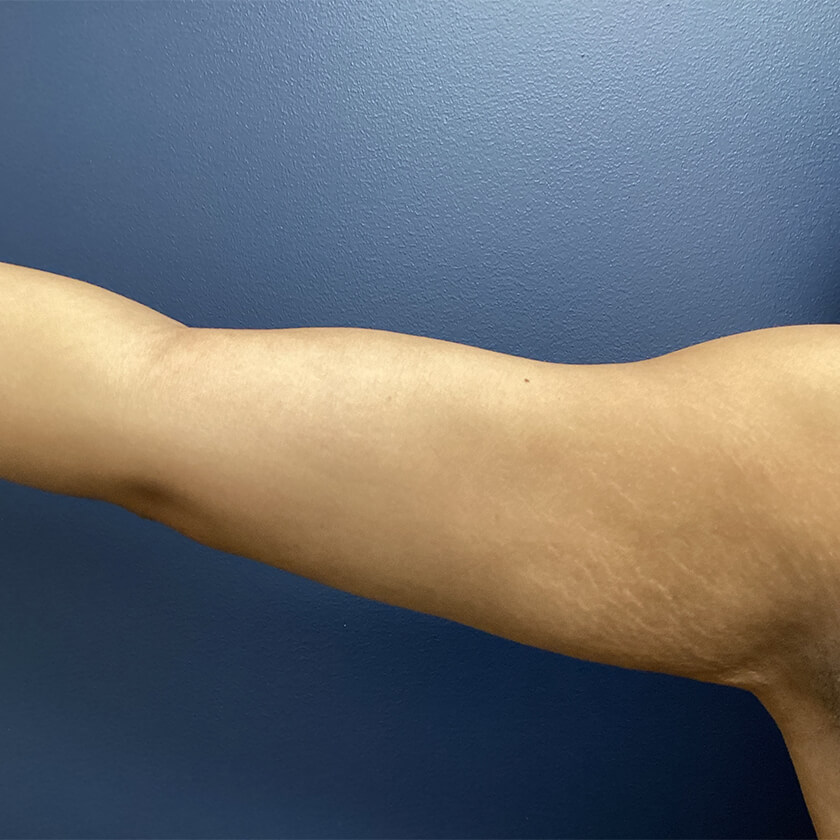 Liposuction before and after - after