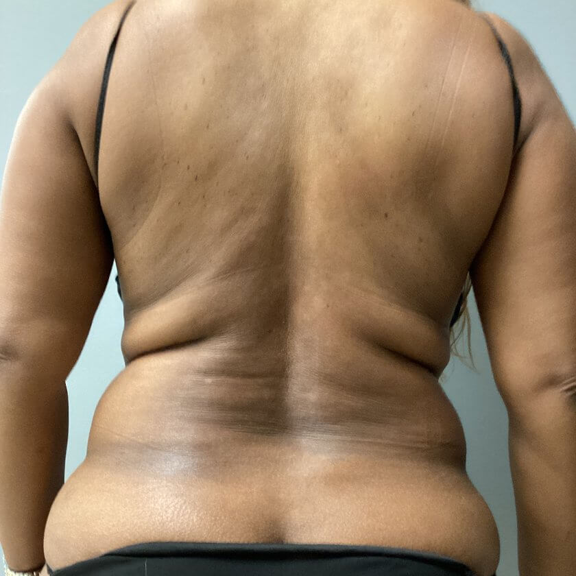 Liposuction before and after - before