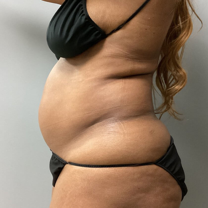 Liposuction before and after - before