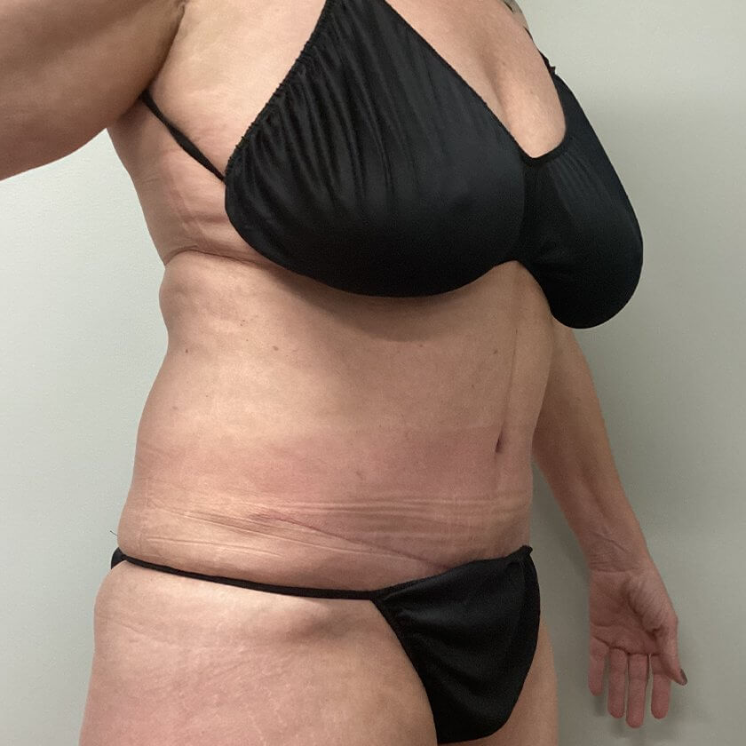 Mommy Makeover before and after - after