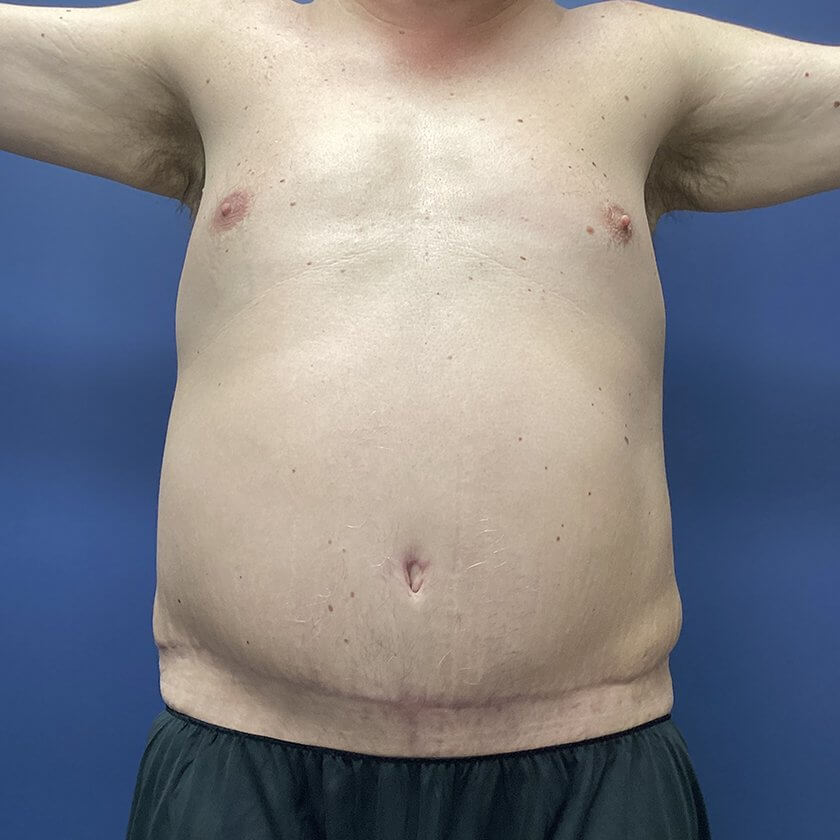 Liposuction before and after - after