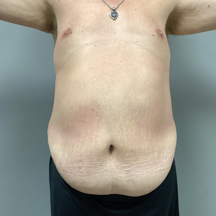 Liposuction before and after - before
