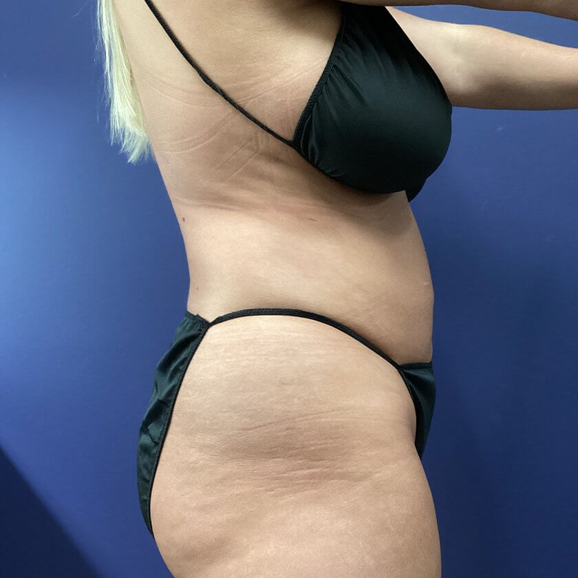 Liposuction before and after - after